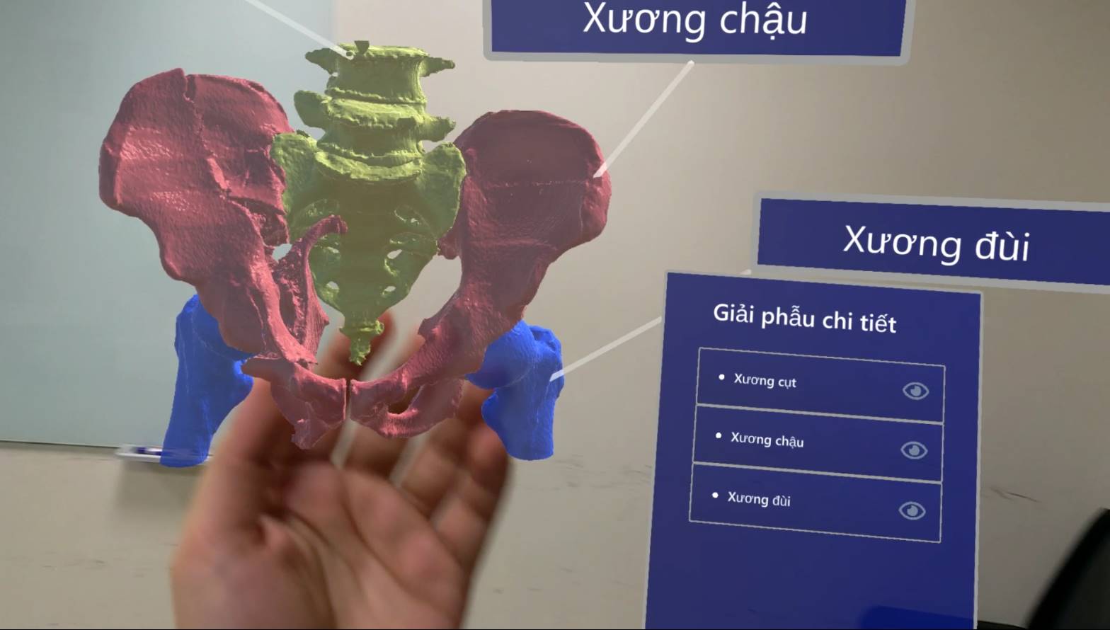 Mô hình xương chậu của một bệnh nhân bị tai nạn rạn vỡ được tái tạo